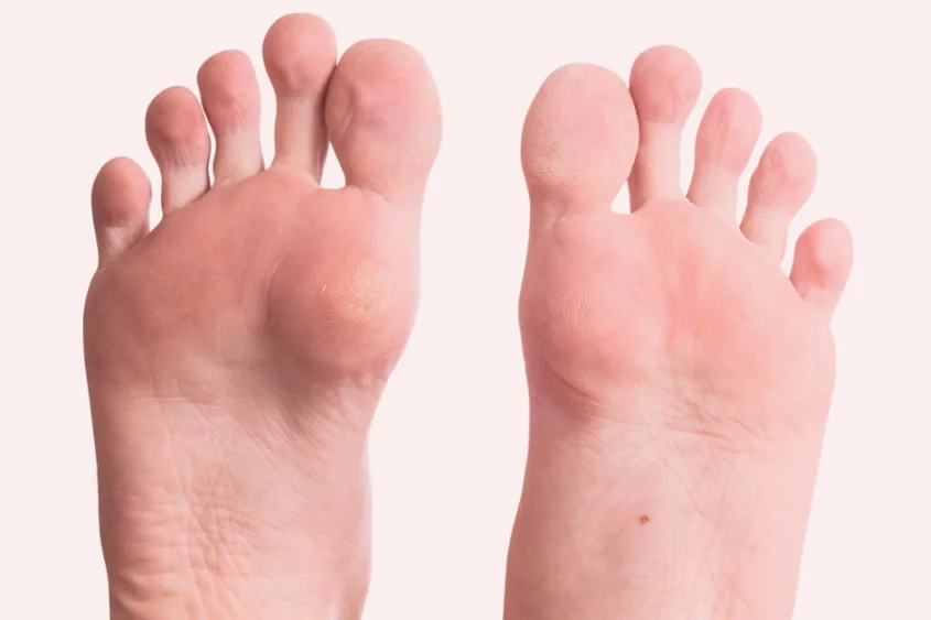 Common Foot Problems Prevention