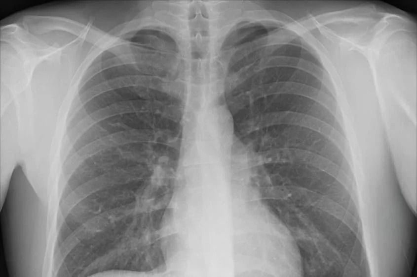 costochondritis icd 10