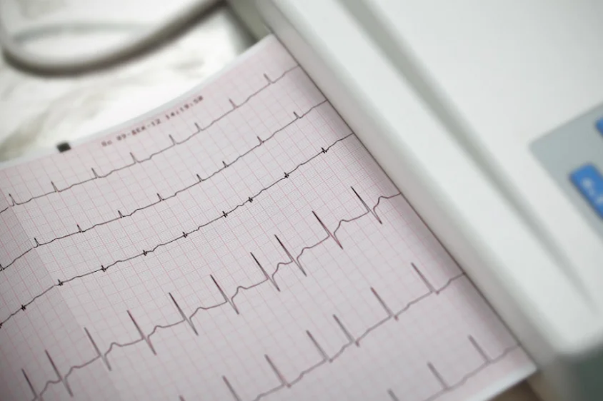 icd 10 bradycardia