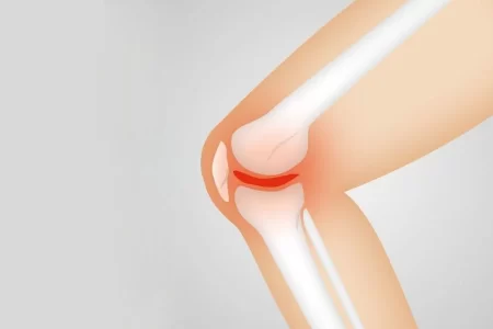 Stem Cell Treatment for Knee Osteoarthritis