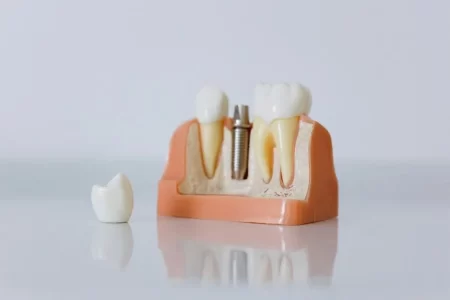 Tooth Loss and Overall Health
