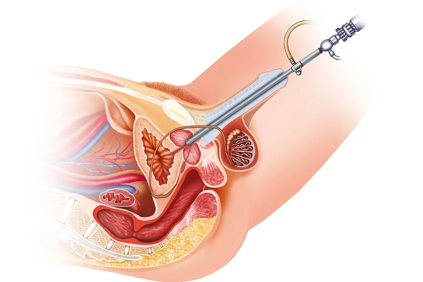 Transurethral Resection of the Prostate