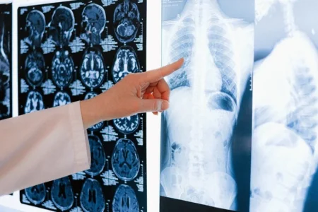 Mesothelioma Cancer