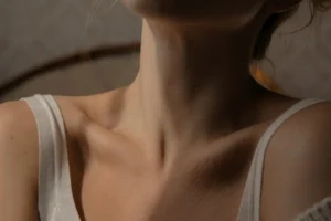 Spider Veins