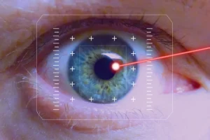 LASIK corneal thinning