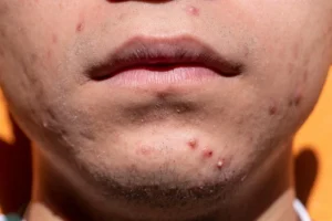 Types of Acne