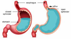 Why GERD Needs Immediate Attention: The Risks of Ignoring Acid Reflux gerd-reflux-acid-disease