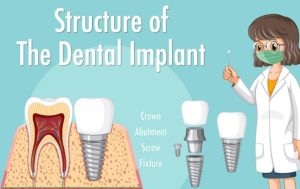 Dental implant replacing a missing tooth with a titanium implant post and natural-looking crown