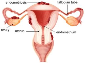 Endometriosis and fertility