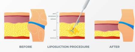 waist contour before and after liposuction body contouring.