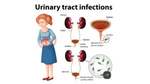 Medical illustration of the urinary tract showing the kidneys, ureters, bladder, and urethra